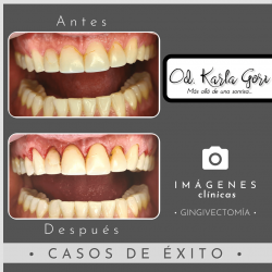 gingivectomia-karla-gori-odontologia-colombia-bogota-cedritos-foto