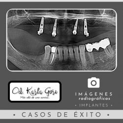 implantes-karla-gori-odontologia-colombia-bogota-cedritos-foto