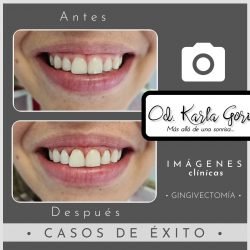 Gingivectomía odontología Bogotá Cedritos