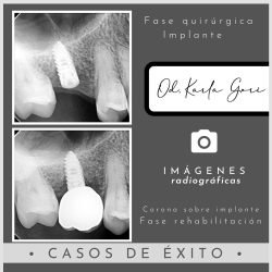 karla-gori-odontologia-bogota-colombia-cedritos-cirugia-oral-4